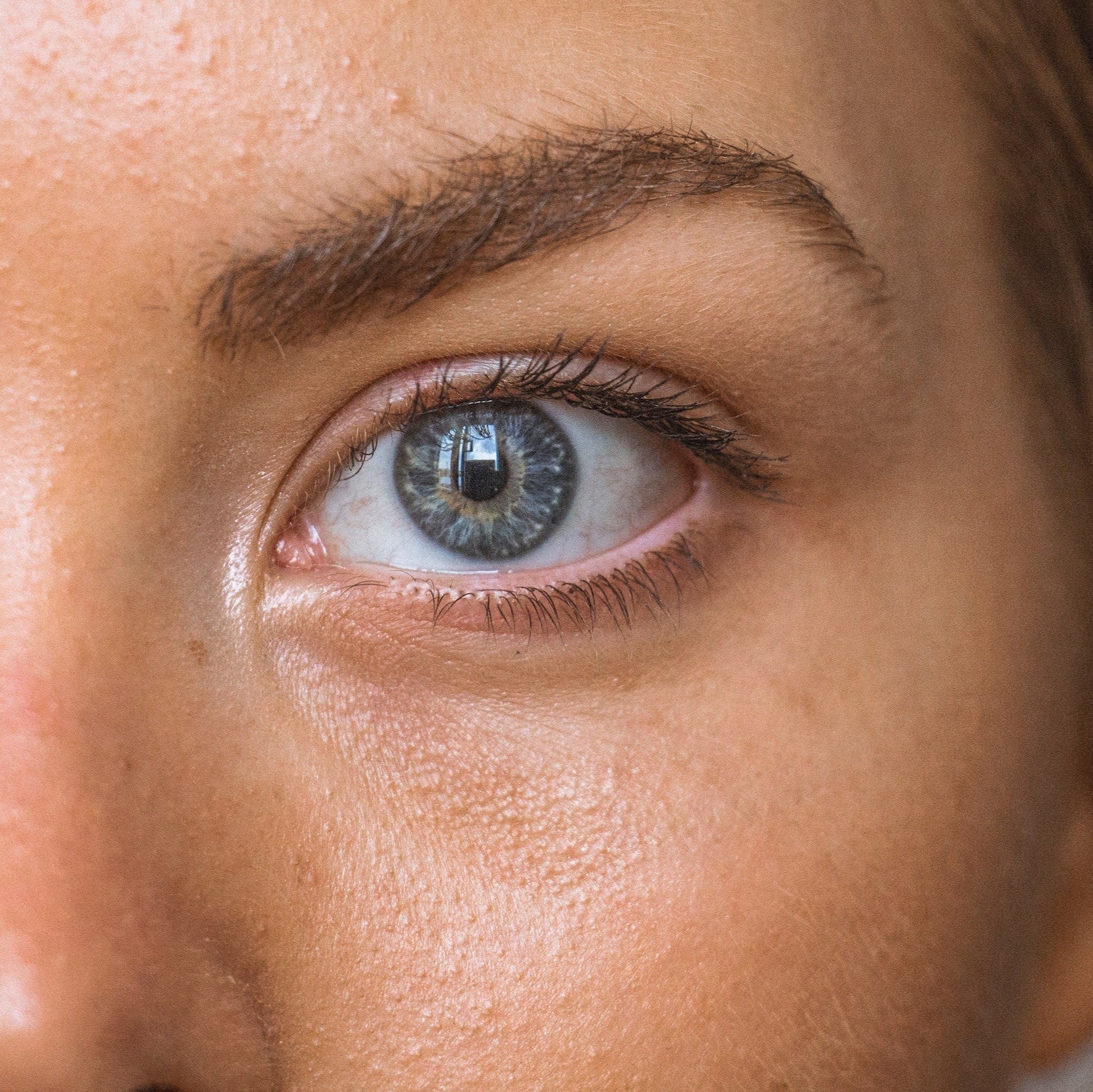 Bright Eyes Ahead: Common Causes & Solutions for Dark Under-Eye Circles